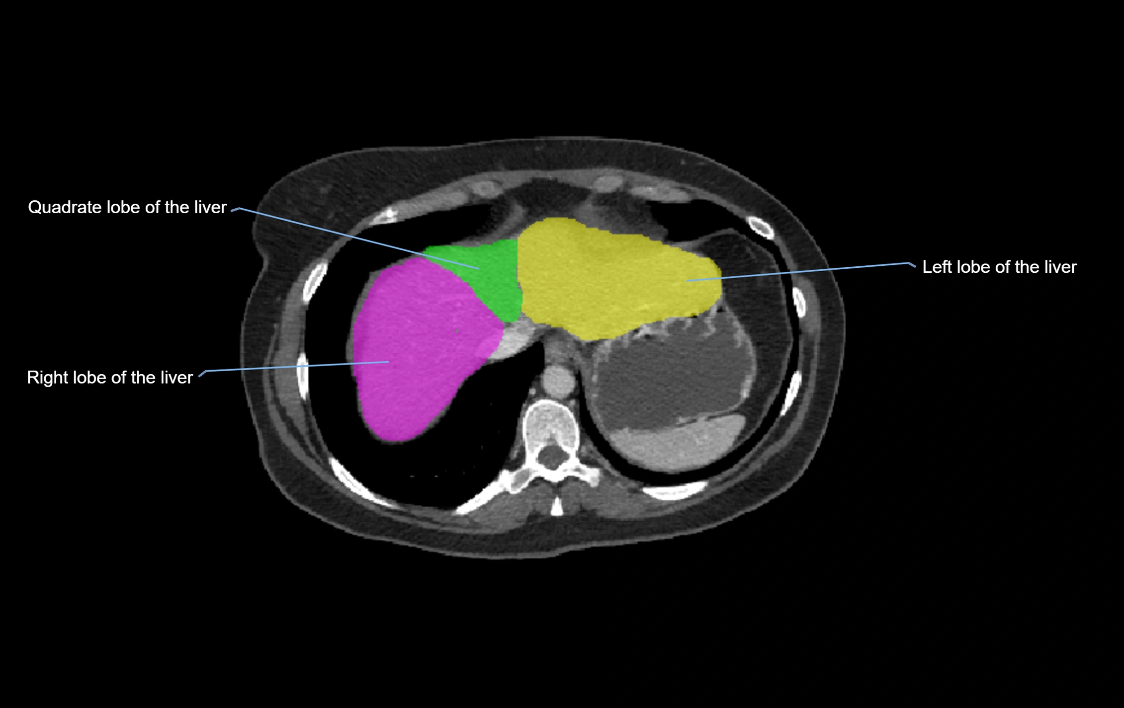 CT lliver lobes axial cross sectional anatomy labelled image -00069.webp